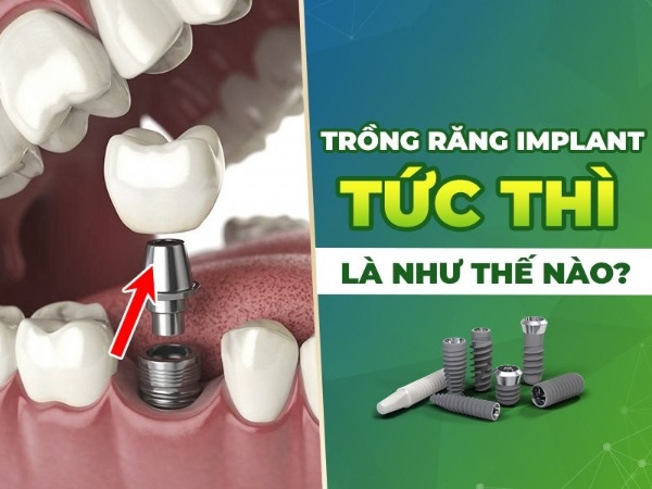 Trồng implant tức thì